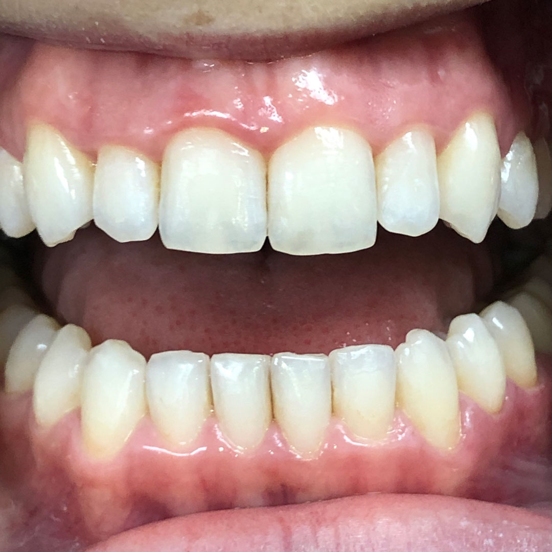 invisalign-2-after