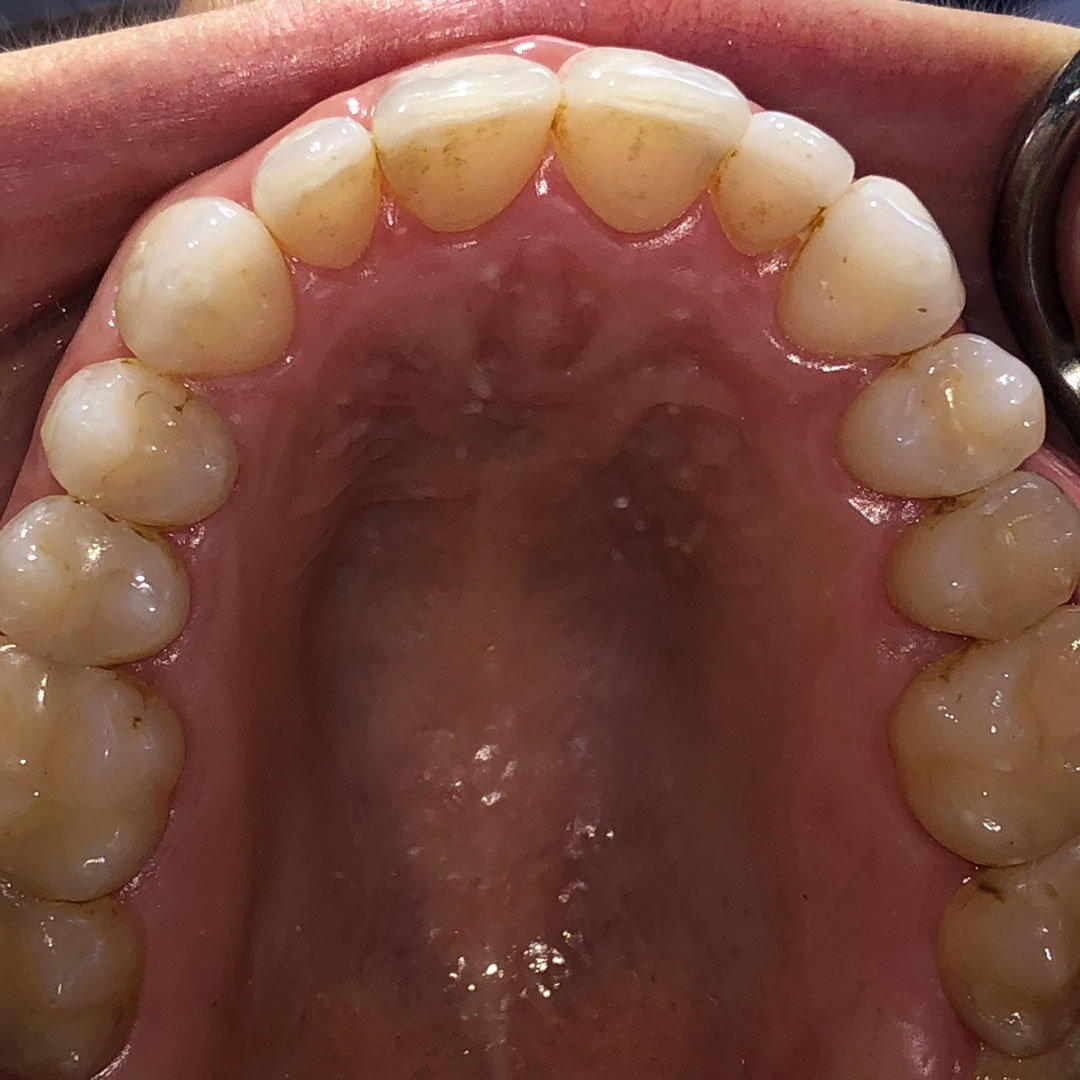invisalign-4-after