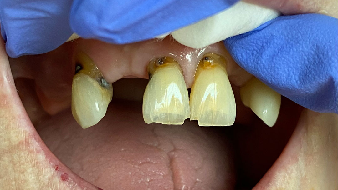 dentalCrown-5-before