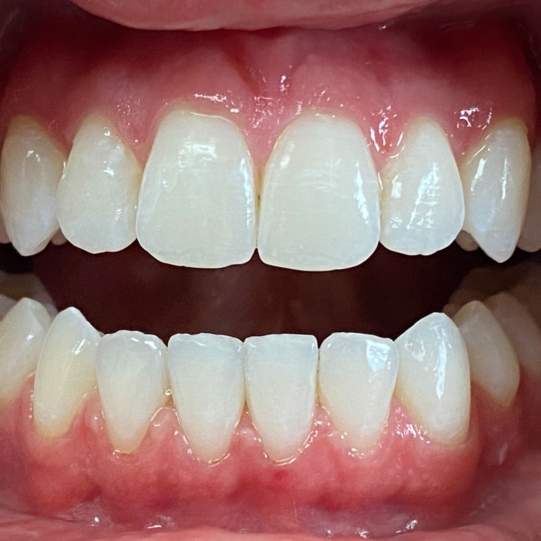 invisalign-5-after