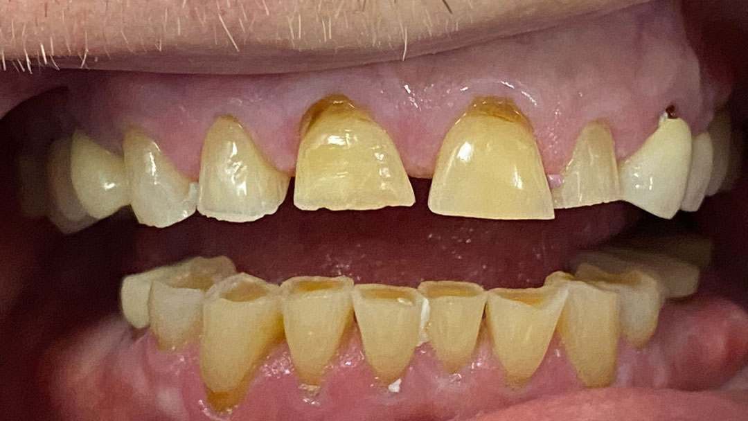 dentalCrown-4-before