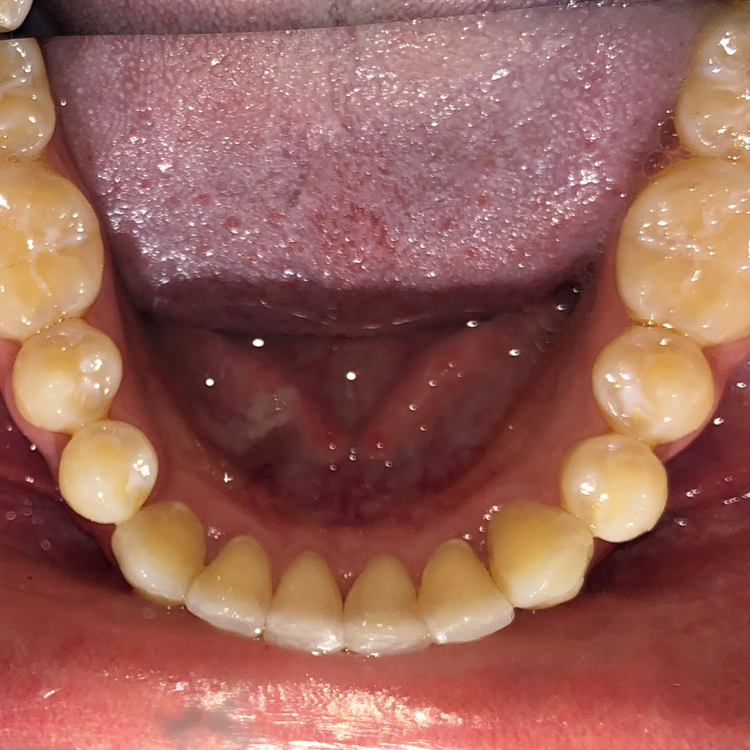 invisalign-3-after