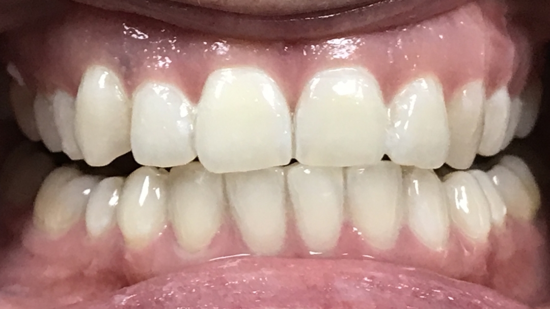 whitening-2-after