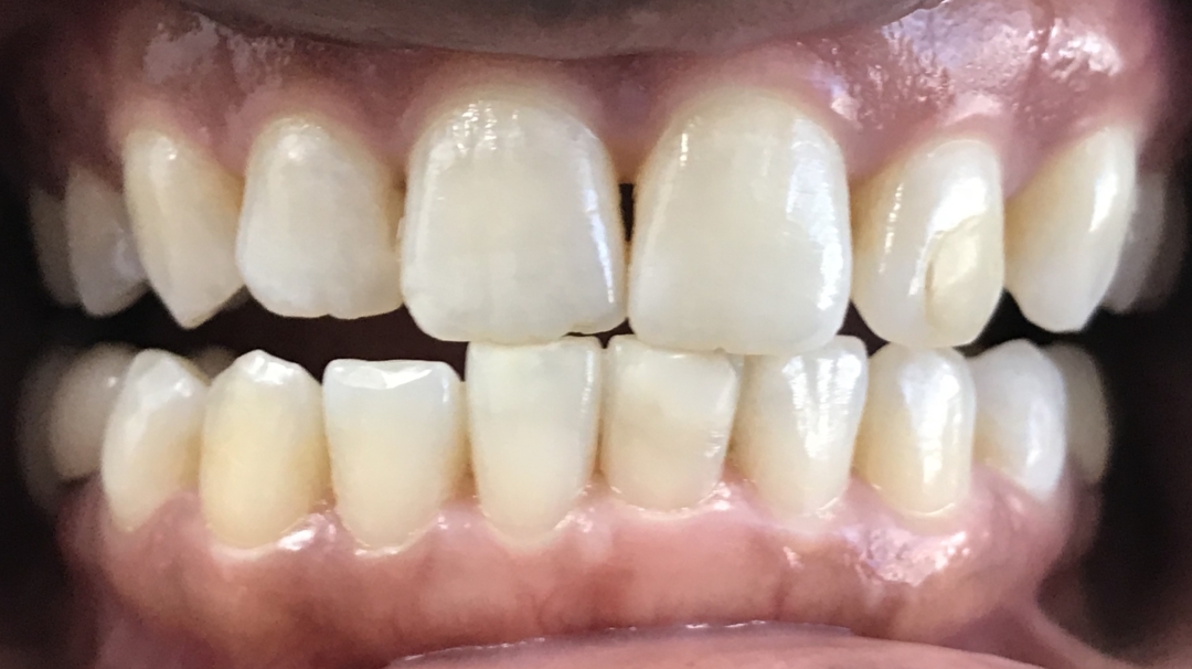 whitening-1-after