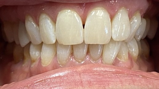 whitening-3-after